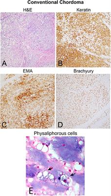 Translational Windows in Chordoma: A Target Appraisal